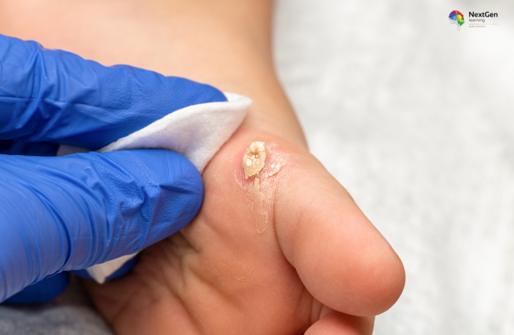 Plantar Wart Treatment