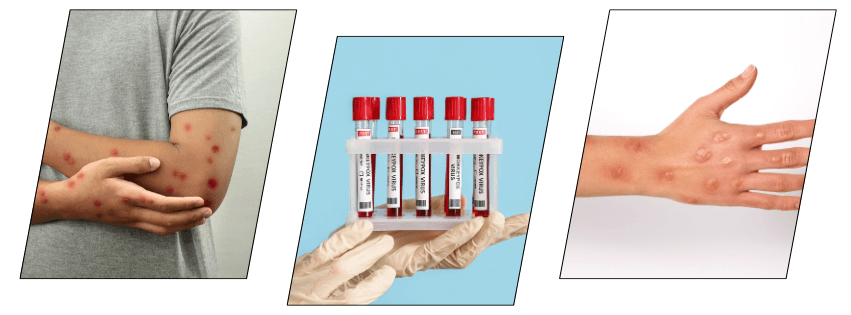 Monkeypox symptoms and prevention awareness for workplace safety